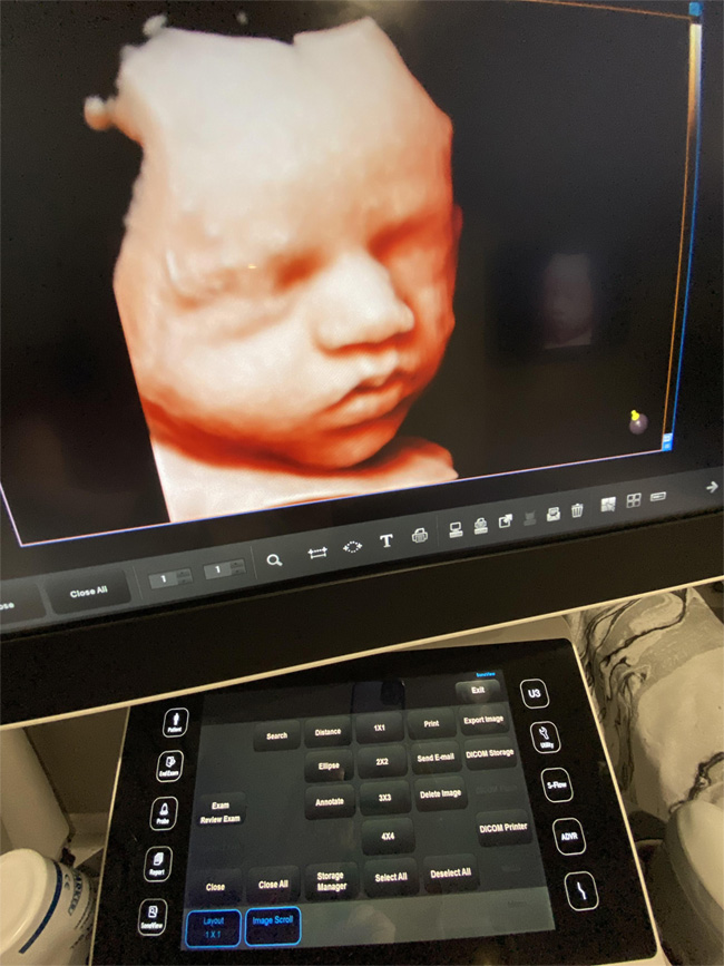 Baby ultrasound Brisbane