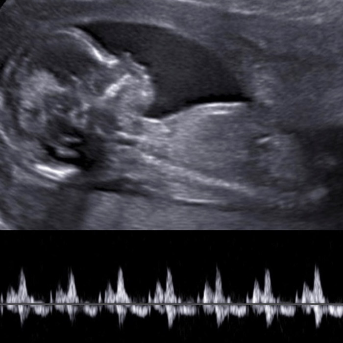 Reassurance Scan - Baby Ultrasound